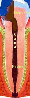 Carie4.jpeg (30964 octets)
