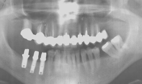 Implant9.jpeg (12860 octets)