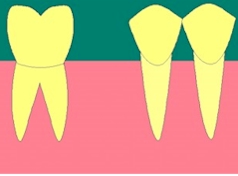 des_implant1.jpeg (21590 octets)
