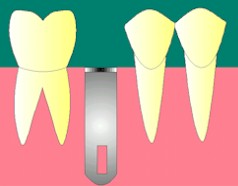 des_implant2.jpeg (9047 octets)