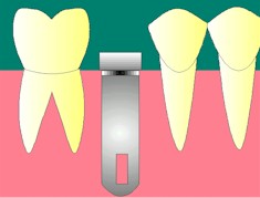 des_implant3.jpeg (9809 octets)