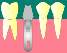 des_implant4.jpeg (23814 octets)
