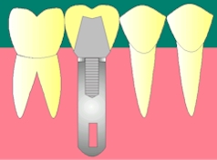 des_implant5.jpeg (23060 octets)